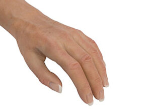 Upper and Lower Limb Prosthetics | Upper Limb | Custom Silicone Prosthetics